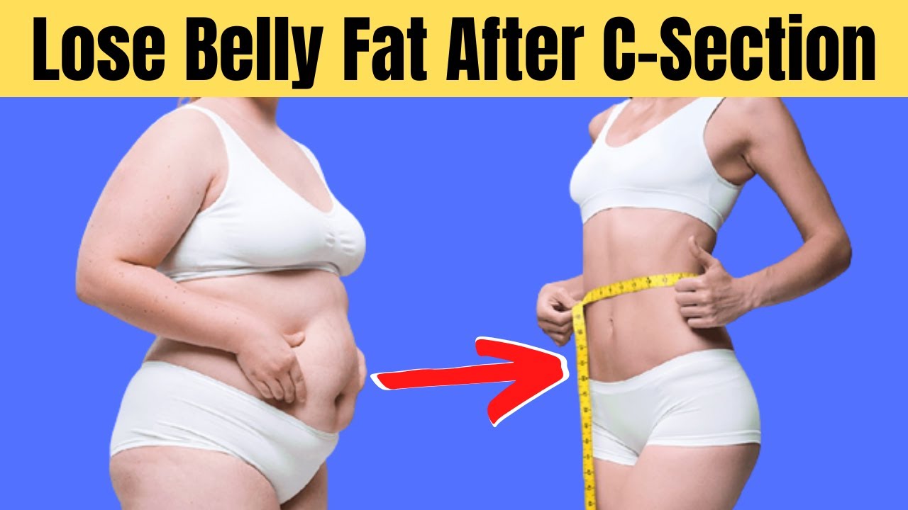 Belly Fat After C Section – Know about the procedure 