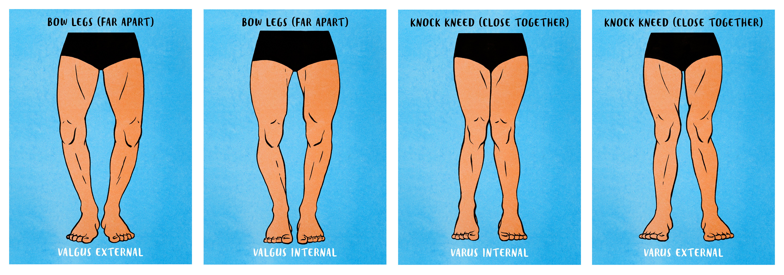 The Causes, Symptoms, and Diagnosis of Knock Knee