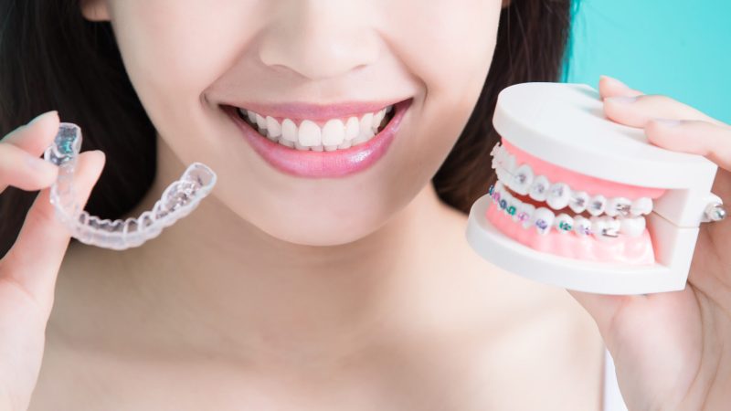 Unlocking The Smile Makeover: The Science Behind How Dental Aligners Work to Straighten Teeth